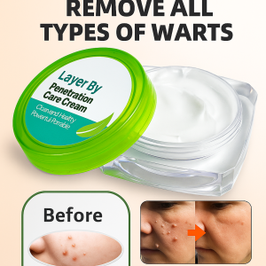 Powerful Wart Removal Cream Quickly Reduces Warts And Provides Gentle Care Wart Removal Cream