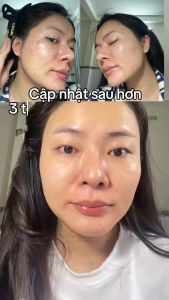Kem SKINOREN 20% azelaic acid hỗ trợ giảm mụn thâm nám tuýp 30g