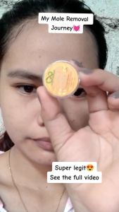 Kasoy Cream - Mole Remover Warts Remover & Skin Tags Remover  I Love Nature Organics