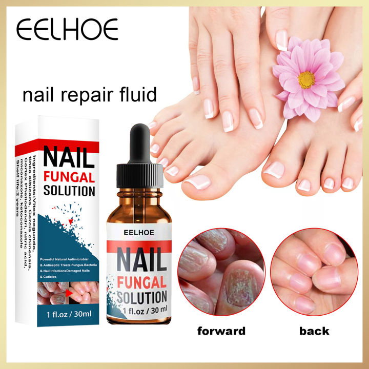 Eelhoe Nail Fungal Solution Foot Nail Fungus Removal Gel Anti-infective ...