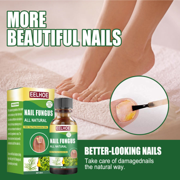 Nail Fungus Treat Onychomycosis Toe Treat Feet Care Nail Repair Nail ...