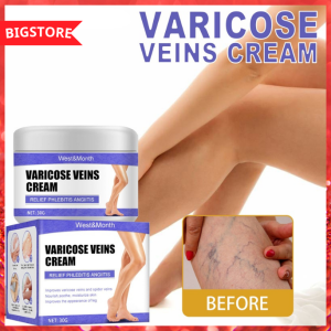Varicose Vein cream leg varicose leg swelling Vein repair