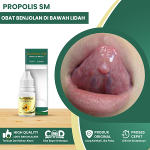 Obat Benjolan Di Bawah Lidah Obat Benjolan Di Lidah Anak Dan Dewasa Obat Benjolan Di Langit Mulut Obat Benjolan Di Lidah Obat Radang Lidah Dengan Propolis SM