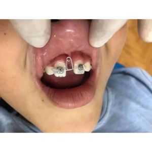 Loop Đóng Khoảng + 2 Mắc Cài Niềng Răng - Loop Nha Khoa