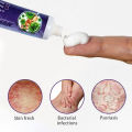 SUMIFUN Antibacterial Cream Gamot Sa Pigsa Gamot Sa Kati Kati Sa Balat Ointments For Skin Deases Cream Para Sa Kati Kati. 