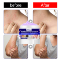 Antibacterial Cream Eczema Treatment Cream Atoderma Cream Original Fungisol Anti Fungal Cream Anti Itch Cream. 