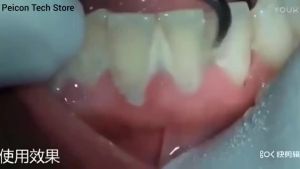 New Ultrasonic Scaler Dental Tartar Remover Electric Sonic Dental Calculus Remover Plaque Stains Removal Household Tooth Cleaner