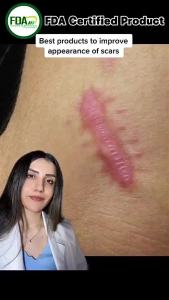 LANBENA Scar Remover Cream 4 Plant Extracts Fading Face Scar Remove Stretch Marks Acne Pimple Scar Removal Cream 2Pcs