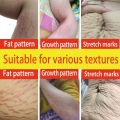 Stretch mark cream scar remover cream Stretch Marks Remover Skin Repair Cream 50g Special for Pregnancy Postpartum Care Remove pregnancy scars. 