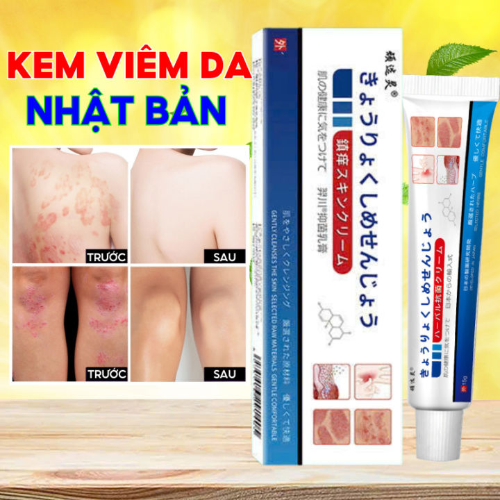 (Nấm-nhật) Kem Bôi Da NHẬT BẢN Dứt Điểm Viêm Da Cơ Địa Nấm Ngứa, Hắc ...