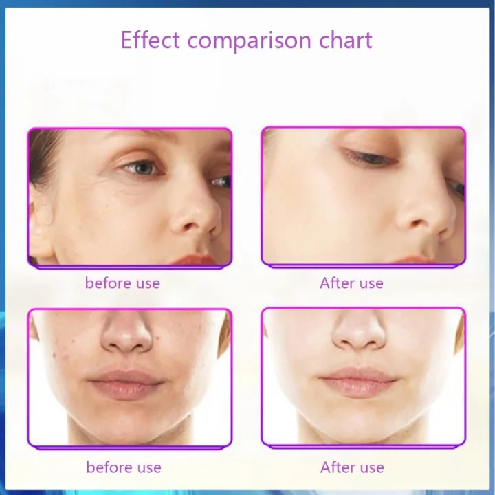 Cautery%20Machine%20Warts%20Removal%20for%20Warts%20Suitcase%20Portable%20Laser%20Mole%20Remover%20Electronic%20Laser%20Plasma%20Pen%20Facial%20Freckle%20Dark%20Warts%20Spot%20Mole%20Removal%20Machine%20Face%20Skin%20Care%20Beauty%20Tool%20Laser%20Warts%20Removal%20Machine%20-%20Image%205