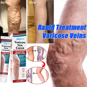14 Days Varicose Veins Treatment Cream Varicose Veins Remover Effectively Dredge Vein Effectively Soothing Varicose Vein Soothing Leg Pain and Earthworm Leg Relief Leg Vasculitis Phlebitis Pain-152c4c8b