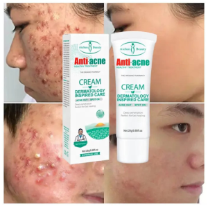 Kem Hết Mụn Anti-Acne Hiệu Quả Được Các Viện Khuyên Dùng Ngừa Mụn Mờ Thâm Hiệu Quả Dưỡng Ẩm Làm Trắng Sáng Da Mịn Màng 20G