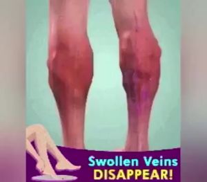Varicose Veins Remover Spray Effective Relief From Painful Leg Veins Treatment spray 30ml Original