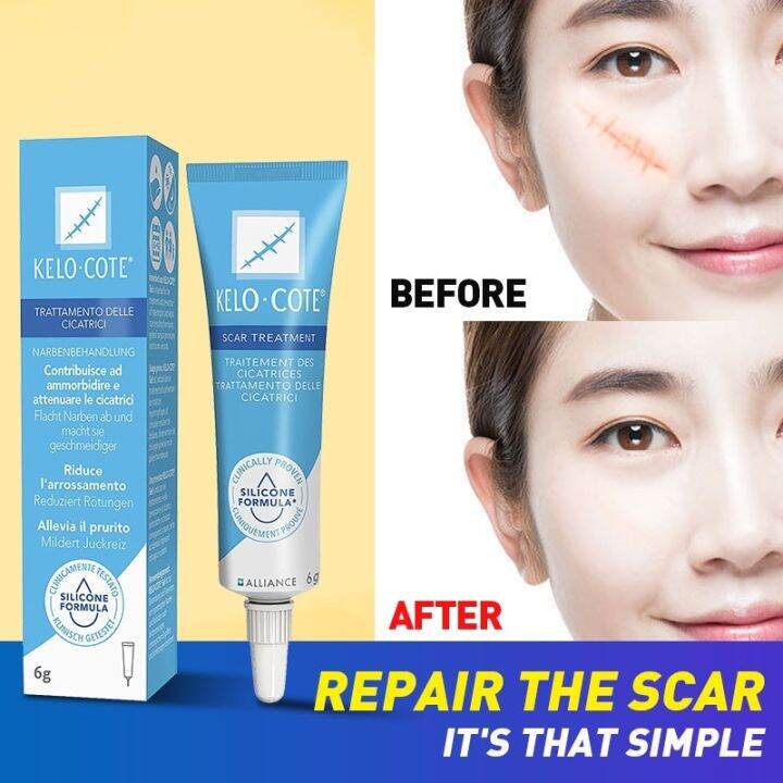 【Hot sale】 America Kelo·Cote Scar Removal Cream Stretch Mark Remover ...