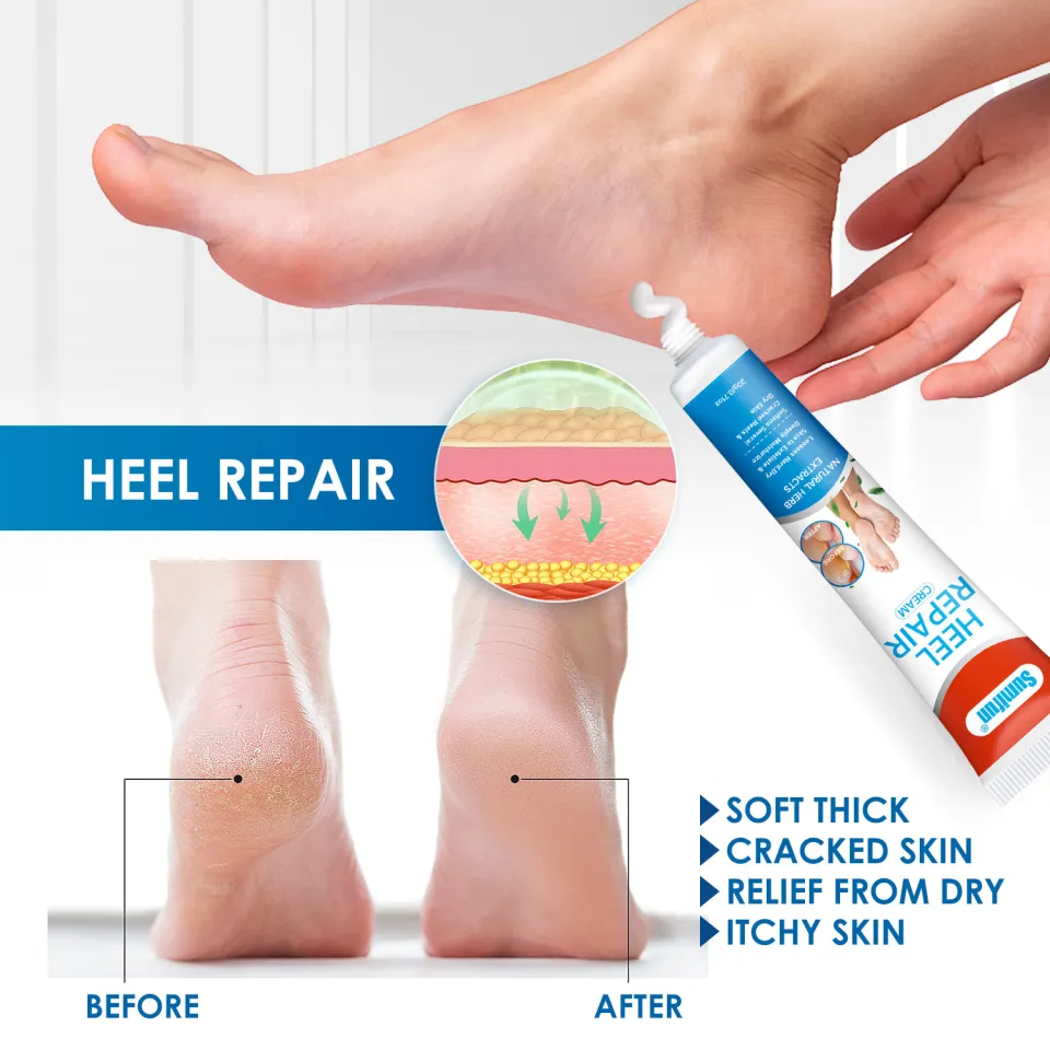 Fungal Infection Cracked Heels Fungus Sumifun Anti-fungal
