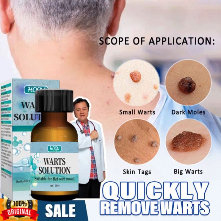 Wart Solution Wart Remover Liquid 25ml Original Wart and Mole Remover