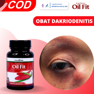 Obat Dakrioadenitis / Radang Kelenjar Air Mata Saluran Air Mata Tersumbat Penyumbatan Saluran Air Mata Obat Mata Merah Dan Sakit Mata Perih Penglihatan Kabur Dengan Oil Fit