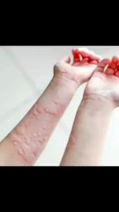 SABUN GATAL HERBAL BPOM ATASI GATAL KULIT| BIDARA SIRIH