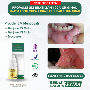 Obat Benjolan Di Mulut Obat Benjolan Di Bibir Obat Benjolan Di Lidah Kronis Obat Penghilang Benjolan di Bawah Lidah Obat Mucocele Obat Benjolan di Bibir & Mulut Obat Benjolan di Langit Langit Mulut Obat Herbal Kelenjar Mukokel