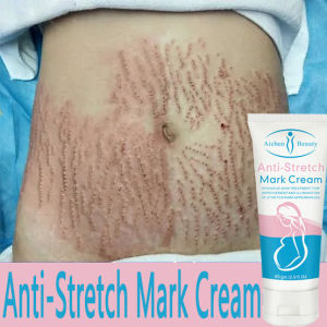 Xoài Xóa Sẹo Mang Thai Kem Rạn Da Kem Làm Săn Chắc Cơ Thể 60g