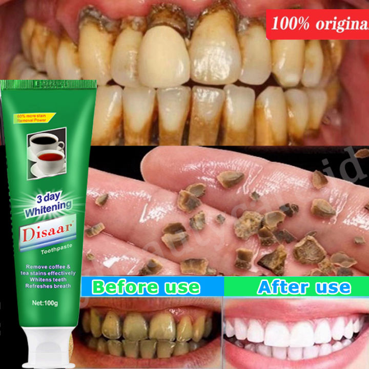 Teeth Whitening Toothpaste Remove tartar and clean yellow teeth