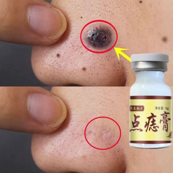 Warts removal cream Skin tag removal Mole remover cream Concentrated