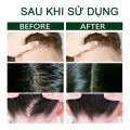 Dầu gội nấm da đầu dược liệu Tinea chống ngứa giảm gàu, rụng tóc và nấm ngứa da đầu - 100ml. 