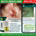 Obat Benjolan di Ketiak, Obat Untuk Menghilangkan Benjolan di Ketiak, Pembengkakan Kelenjar Getah Bening di Ketiak, Benjolan Kecil Dan Lunak Di Ketiak Kiri, Bisul Di Ketiak, Benjolan Di Lipatan Ketiak Dengan ProPolis SM. 