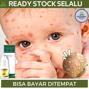 Obat Cacar Air Obat Cacar Api Obat Bintik Di Kulit Bintik Berair Obat Penghilang Bintik Berair Obat Herpes Cacar Monyet Campak Obat Luka Cacar Obat Gatal Cacar Cacar Bernanah Obat Cacar Anak Dan Dewasa Dengan Propolis SM