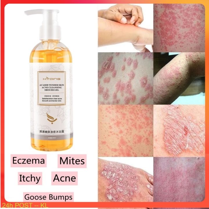 Acne body wash Antibacterial and Removal of mites Acarid tender skin