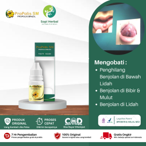 Obat Benjolan di Bawah Lidah Obat Benjolan di Bibir & Mulut Obat Penghancur Benjolan Mulut Obat Benjolan di Langit Langit Mulut - Propolis SM