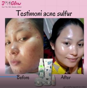 Jglow Skincare Paket Extra Acne Sulfur: Perawatan Wajah Terlaris