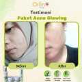 Orlin Beauty Paket Acne Glowing Platinum 4in1 Mencerahkan Wajah Kulit Sensitif Bekas Jerawat Flek Hitam Skincare BPOM. 