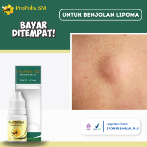Obat Benjolan Lipoma Obat Penghancur Benjolan Obat Penghilang Benjolan Obat Benjolan Di Tubuh Obat Penghancur Lemak Lipoma Obat Pengempis Benjolan Obat Benjolan Tiroid Obat Kelenjar Getah Bening Dengan Propolis SM