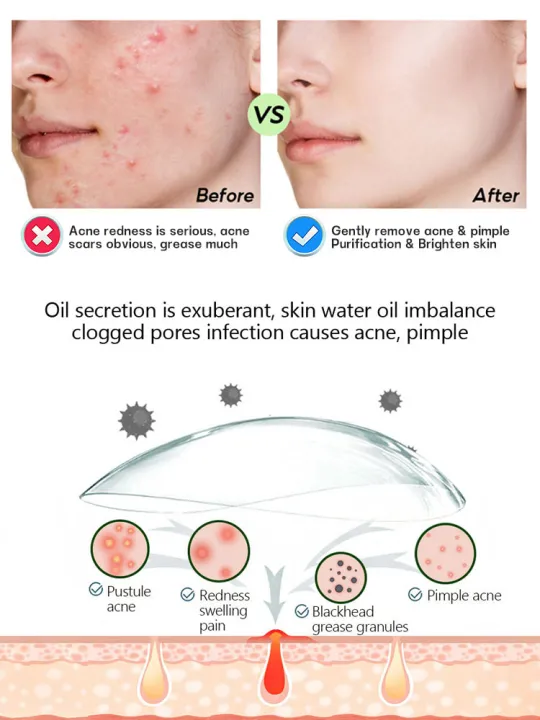 Crema facial para eliminar cicatrices de acné, tratamiento de belleza Aichun, crema antiacné para el cuidado de la piel, crema para los poros