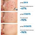 Anti Acne Cream Pimple Scars Remover For All Skin Types 100% Facial Solution Effective Treats Acne Remove Blemish Surgery Scars Acne Breakouts Treatment For Acne Problem Natural Ingredients Extract Best Acne Remover. 