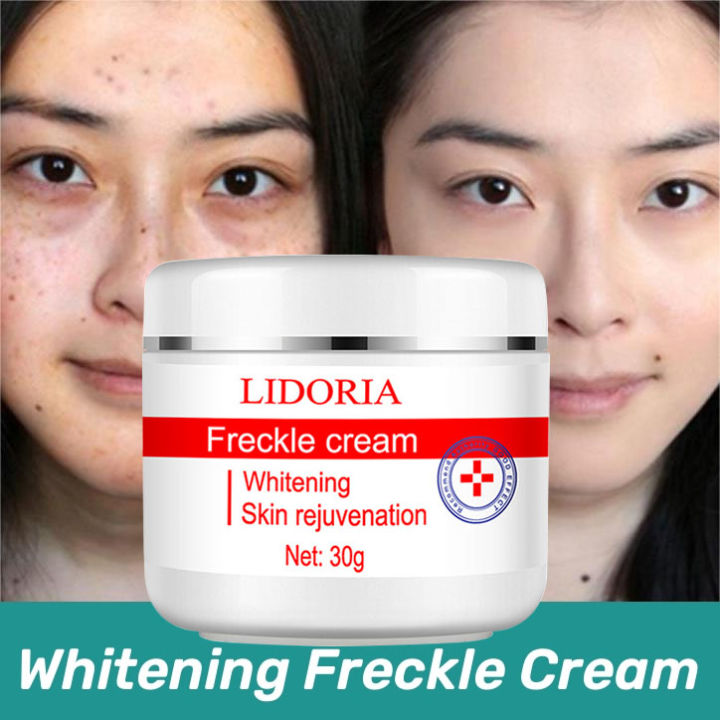 Authentic Freckle Removal Whitening Cream 30g Melasma And Pekas Remover Cream Facial Whitening