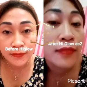 (PRODUK 100% ORIGINAL)HI GLOW SKINCARE PAKET ULTIMATE REMOVE SPOT