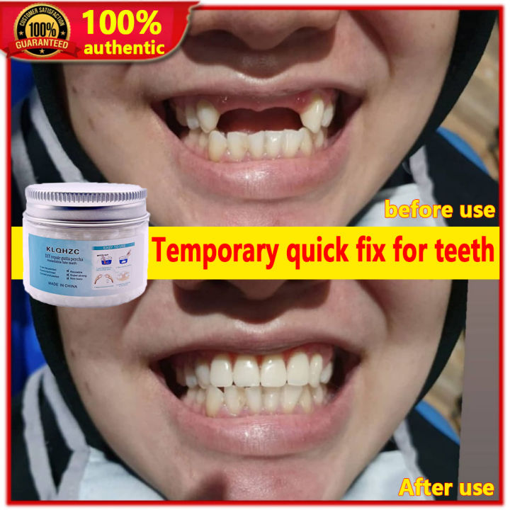 【Fast filling】DIY Tooth Repair Kit Temporary Teeth Restoration 50g Artificial temporary tooth teeth Teeth And Gaps FalseTeeth Solid Glue Denture Adhesive Glue Decorative Denture Tooth Repair Glue Moldable False Teeth