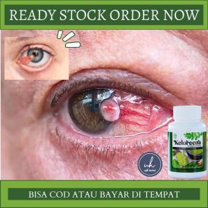 Obat Penghilan Selaput Lemak Mata Obat Mata Pterigium Obat Pembersih Mata Obat Penyakit Mata Obat Selaput Pada Bola Mata Obat Penjelas Penglihatan Obat Untuk Mata Minus Mata Katarak Buram Obat Lamad Mata Obat Mata Berlemak Dengan Keloreena