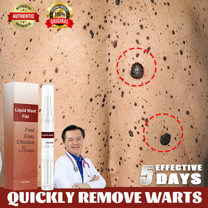 Warts Remover Original Watson Warts Removal Kasoy Oil Warts Remover ...