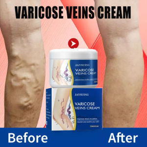 Kem suy giãn tĩnh mạch giúp giảm đau mỏi mất thẩm mỹ do/20g