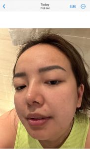 ROSMAR SHOKYO ACNE SPOT SOLUTION