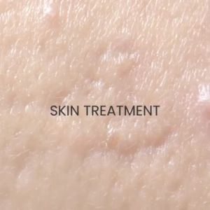 Acne Treatment Acne Scar Remover Facial Cream Skin Care Anti Acne Cream Pores Cream
