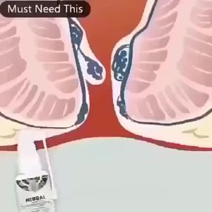 HemorrhoidscrerimBuasirHemorrhoidssprayTreatmentmixedinternalexternalhemorrhoidsubatbuasir100%berkesan
