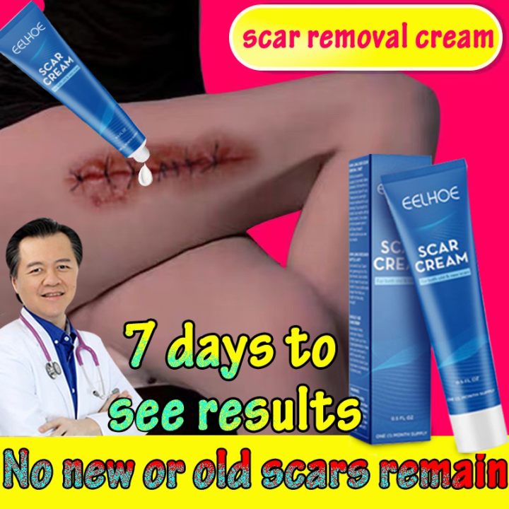 Bekas Caesar Rapi Penghilang Bekas Luka Krim Perbaikan Tanda Pock Membakar Bekas Luka ...
