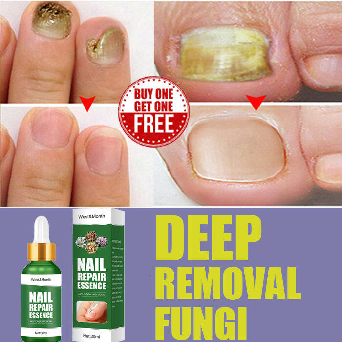 Antibacterial Nail Treatment Essential Anti Fungal Infection Toe ...