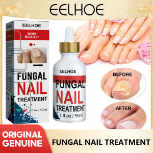 Eelhoe giun đũa của giải pháp sửa chữa chăm sóc móng móng chân móng tay dày trong áo giáp móng tay concavo-lồi sửa chữa móng tay màu xám phục hồi dạng lỏng móng tay trị nấm móng tay giải pháp sửa chữa móng tay dày lên sáng loại bỏ da chết sửa chữa chăm só