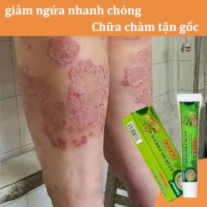 Sumifun Kem bôi dứt điểm nấm da vảy nến eczema á sừng - hắc lào mề đay viêm da cơ địa viêm da tiếp xúc - thành phần thiên nhiên an toàn hiệu quả thấy rõ chỉ sau 2-3 ngày dùng